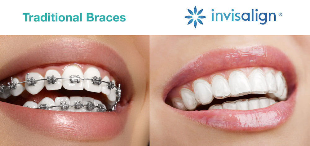 Invisalign vs Braces